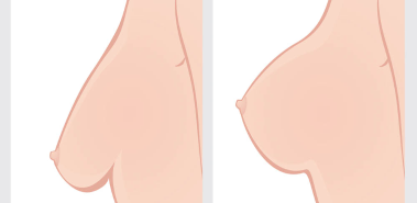 Breast Lift - Costa Rica